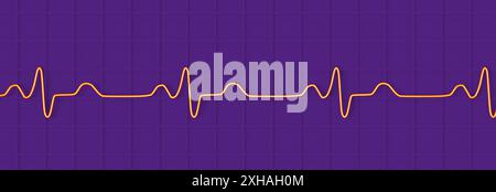 Illustration of an electrocardiogram (ECG) depicting a bundle branch block. This occurs when something blocks or disrupts the electrical signal that causes the heart to beat. The ECG shows widened QRS complexes and altered ventricular depolarisation. Stock Photo