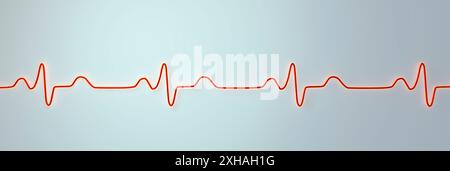 Illustration of an electrocardiogram (ECG) depicting a bundle branch block. This occurs when something blocks or disrupts the electrical signal that causes the heart to beat. The ECG shows widened QRS complexes and altered ventricular depolarisation. Stock Photo