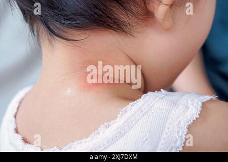cute asian baby girl has rash and allergy on neck skin from mosquito ...