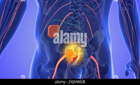 Sacral nerve stimulation medical concept Stock Photo