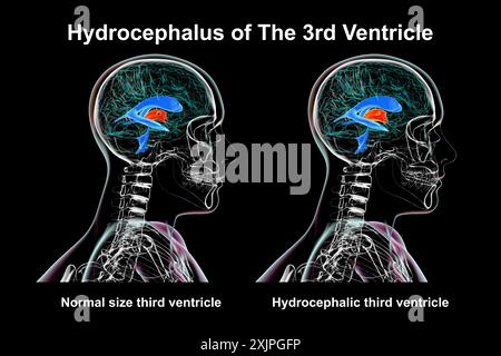 Illustration depicting isolated enlargement of the third brain ventricle (right) compared to the normal size third ventricle (left), side view. Stock Photo