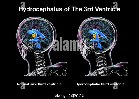 Illustration depicting isolated enlargement of the third brain ventricle (right) compared to the normal size third ventricle (left). Stock Photo