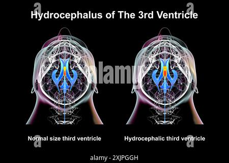 Illustration depicting isolated enlargement of the third brain ventricle (right) compared to the normal size third ventricle (left), bottom view. Stock Photo