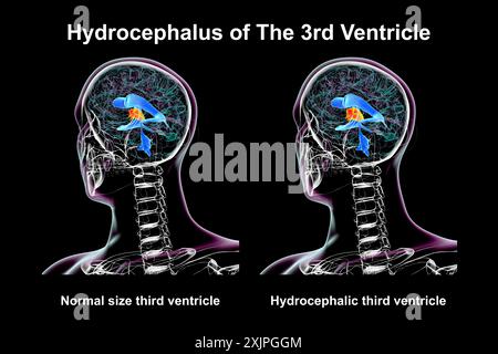 Illustration depicting isolated enlargement of the third brain ventricle (right) compared to the normal size third ventricle (left). Stock Photo