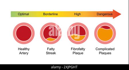 Atherosclerosis stages, illustration Stock Photo - Alamy
