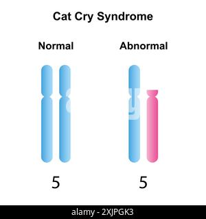 Cat cry syndrome, illustration. Stock Photo