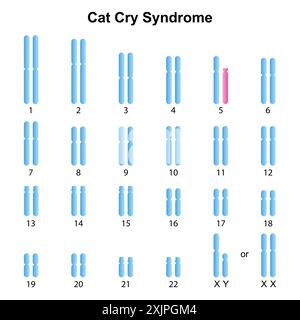 Cat cry syndrome, illustration. Stock Photo