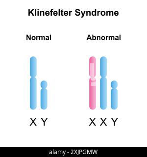 Klinefelter syndrome, illustration. Stock Photo