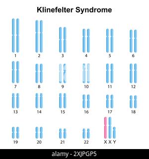 Klinefelter syndrome, illustration. Stock Photo