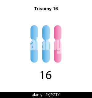 Trisomy 16 syndrome, illustration. Stock Photo