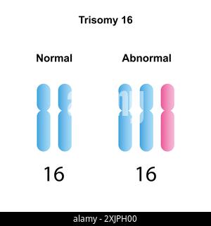 Trisomy 16 syndrome, illustration. Stock Photo