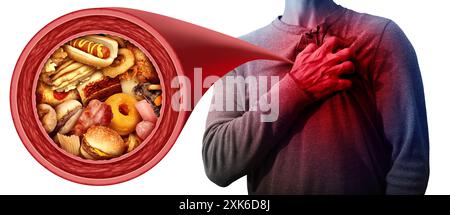 Atherosclerosis and Dietary Fat as Low-density lipoprotein or bad LDL cholesterol with a person suffering from a heart attack due to clogged coronary Stock Photo