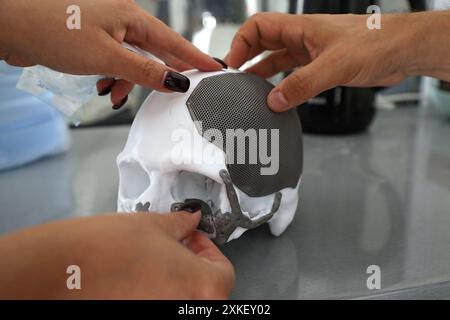KYIV, UKRAINE - JULY 19, 2024 - Titanium implants are applied to areas where bones have been damaged on a 3D-printed skull model of a patient who participated in the Doctors for Heroes charity project, Kyiv, capital of Ukraine Stock Photo