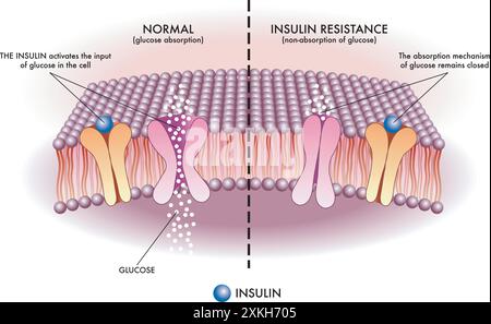 Medical illustration shows in a simple and schematic way the mechanism of insulin resistance, one of the causes of type 2 diabetes. Stock Vector