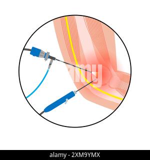 Illustration of elbow arthroscopy surgery. This is a procedure for ...