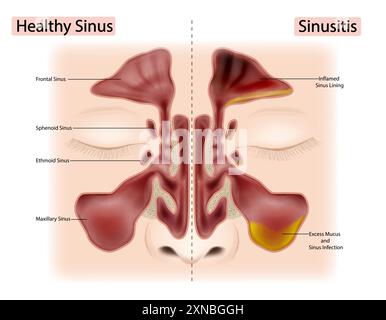 Sinusitis healthy and inflamed nasal sinuses. Human anatomy scientific ...