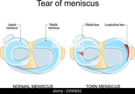 Meniscal tear. Torn meniscus. Knee injury. Cartilage damage. Meniscal repair. Sports injury. Head of tibia seen from above. Vector illustration Stock Vector