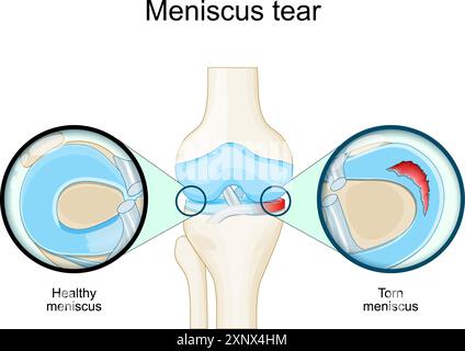 Meniscal tear. Knee anatomy. Close-up of Torn meniscus and cartilage damage. Sports knee injury. Vector illustration Stock Vector