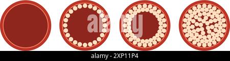 Atherosclerosis thrombus vessel cholesterol level artery. Plaque heart thrombus cardiovascular system blood vector disease illustration Stock Vector