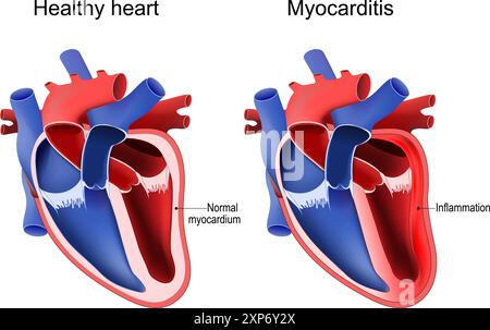 Myocarditis. Healthy heart with Normal myocardium and Cardiac inflammation. Heart anatomy. Vector illustration Stock Vector