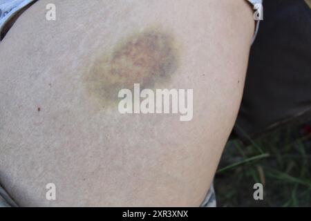 Bruise on the leg. A large round bruise of dark blue color on the leg. Skin injuries. Stock Photo