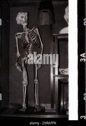 Joseph 'John' Carey Merrick (1862-90) - aka The Elephant Man. Pathology collection of  Royal London Hospital in Whitechapel c.1980s Stock Photo