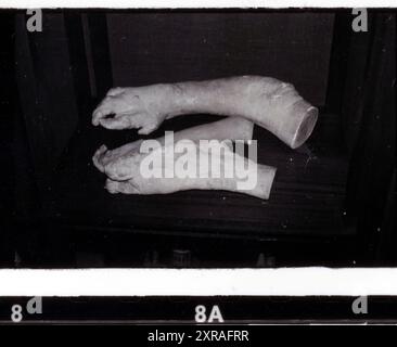 Joseph 'John' Carey Merrick (1862-90) - aka The Elephant Man. Pathology collection of  Royal London Hospital in Whitechapel c.1980s Stock Photo