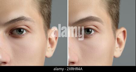 Man before and after permanent eyebrow procedure, collage with closeup ...