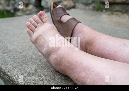 Close-Up of Swollen Lower Leg and Foot Indicating Oedema Stock Photo