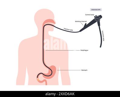 Oesophagogastroduodenoscopy, illustration. Stock Photo