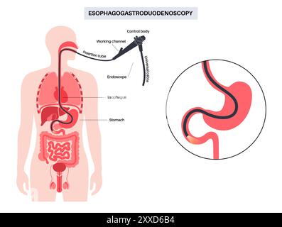 Oesophagogastroduodenoscopy, illustration. Stock Photo