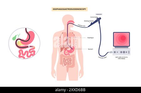 Oesophagogastroduodenoscopy, illustration. Stock Photo