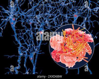 Illustration showing Lewy bodies (red) in neurons (blue) with a close-up showing the molecular structure of a Lewy body. Stock Photo