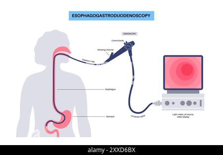 Oesophagogastroduodenoscopy, illustration. Stock Photo