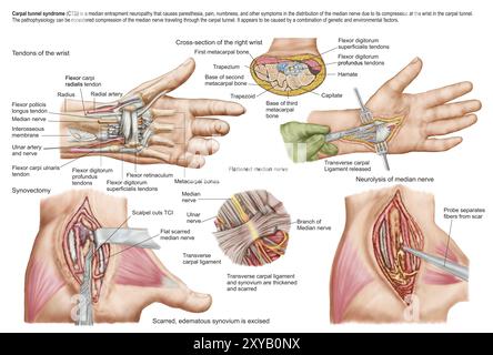 Medical illustration showing carpal tunnel syndrome in the human wrist, and the surgical procedures associated with it Stock Photo