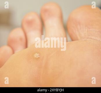 Callus and hyperkeratosis on feet, closeup, dried skin Stock Photo