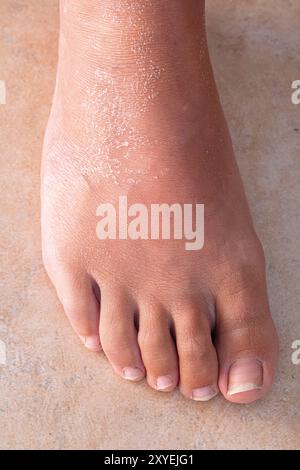 Close-up view of a foot with dry, flaky skin, highlighting a potential skin condition Stock Photo