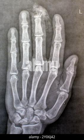 Plain X-Ray reveals distal tip amputation of distal phalanx of the