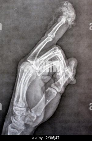 Plain X-Ray reveals distal tip amputation of distal phalanx of the ...