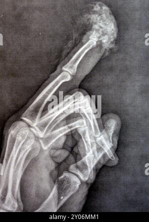 Plain X-Ray reveals distal tip amputation of distal phalanx of the