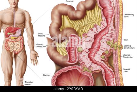 Illustration of diverticulosis in the colon. Diverticulitis is a common digestive disease which involves the formation of pouches (diverticula) within Stock Photo