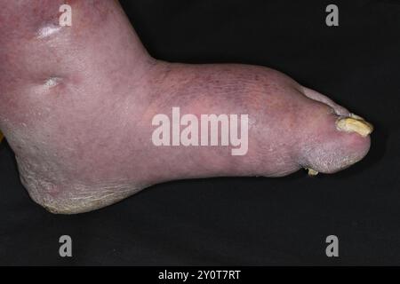 Congenital (present from birth) absence of toes in a 57 year old male patient. Deformities like this are usually caused by damage to the developing foetus in the womb. For further images of this patient see SPL codes C060/1835, C060/1836, C060/1838 and C060/1839. Stock Photo