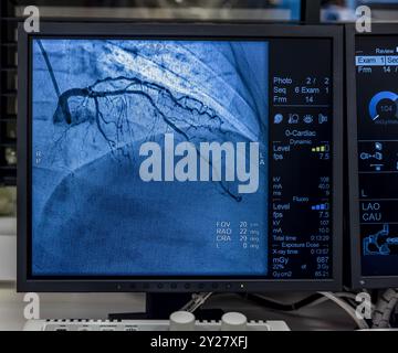 Istanbul, Turkey 28 February 2024; Angiogram sequence working clockwise using x-rays with a contrast agent injected from a tube inserted into the arte Stock Photo