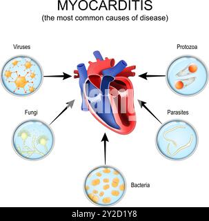 Myocarditis. Cross section of a human heart and the most common causes of disease like Protozoa, Bacteria, Parasites, Fungi, Viruses. Vector illustrat Stock Vector