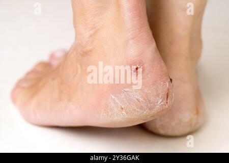 Female feet with cracked heels close up Stock Photo