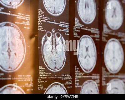 MRI of the human brain of a patient with multiple sclerosis of the ...