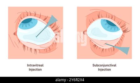 Vector illustration of subconjunctival hemorrhage Stock Vector Image ...