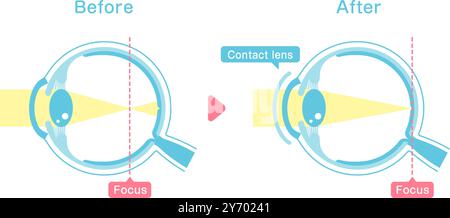 After Vision Process Illustration comparing vision before and after wearing contact lens ...