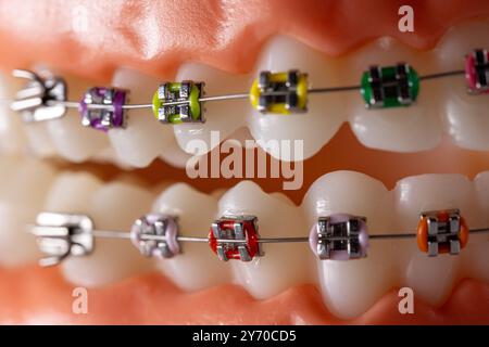 closeup of metal dental braces for teeth straightening Stock Photo - Alamy