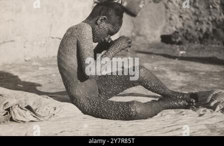 Anti-smallpox campaign Dawaimeh-Hebron in Palestine, January - February 1922: Smallpox epidemic, Palestine. Stock Photo